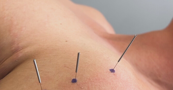 Dry Needling vs. Acupuncture: What’s the Difference—and Which One Is Right for You? image