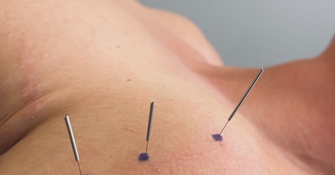 Dry Needling vs. Acupuncture: What’s the Difference—and Which One Is Right for You? image